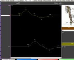 EMS Biomedical Surpass LT software (MNC)