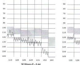 Vibrosense Meter