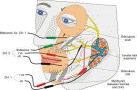 Facial Nerve Monitoring